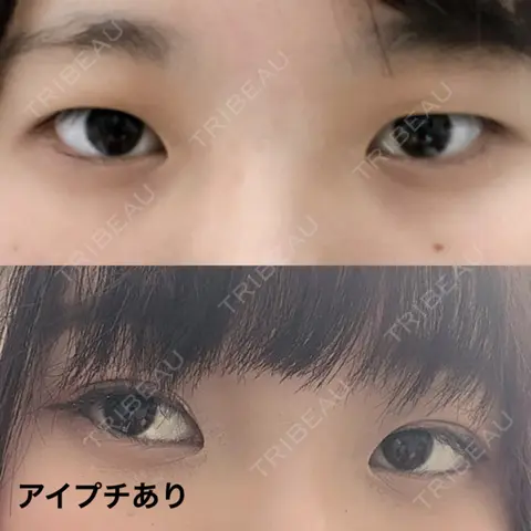 二重埋没 / 目頭切開 TCB東京中央美容外科 仙台駅前院 AFTER