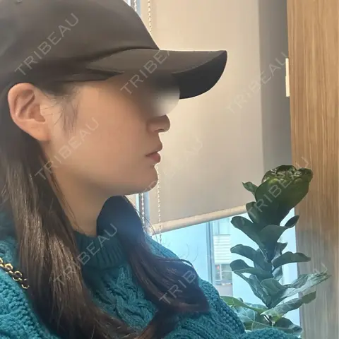 ハイフ（顔） Mavie Beauty Clinic （マヴィービューティークリニック） AFTER
