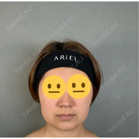 糸リフト / バッカルファット除去 / 脂肪吸引（顔） / ボトックス（エラ・小顔） アリエル美容クリニック 大宮院 AFTER