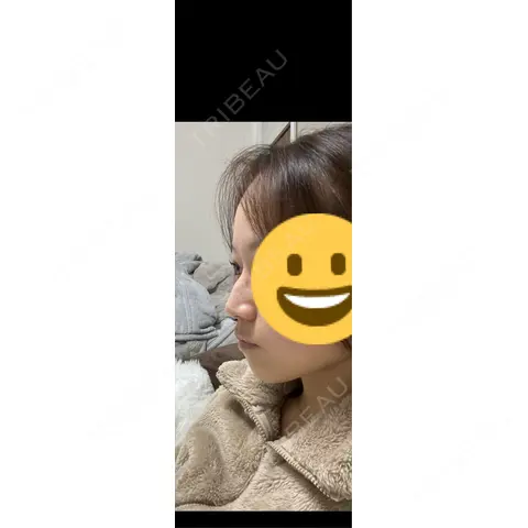 ヒアルロン酸注入（鼻） 日比谷セントラルクリニック AFTER