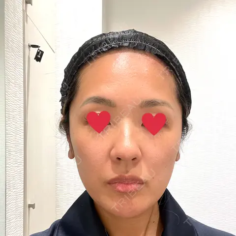 脂肪吸引（顔） Mods Clinic（モッズクリニック） 東京院 AFTER