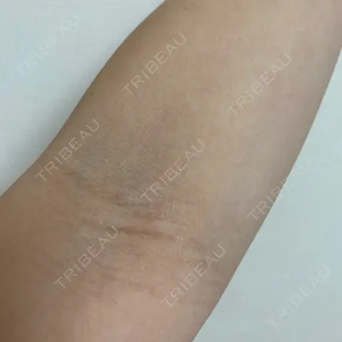 白玉点滴・注射 X CLINIC 大阪院 AFTER