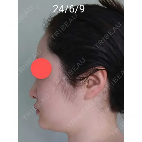 脂肪吸引（顔） Mods Clinic（モッズクリニック） 東京院 AFTER