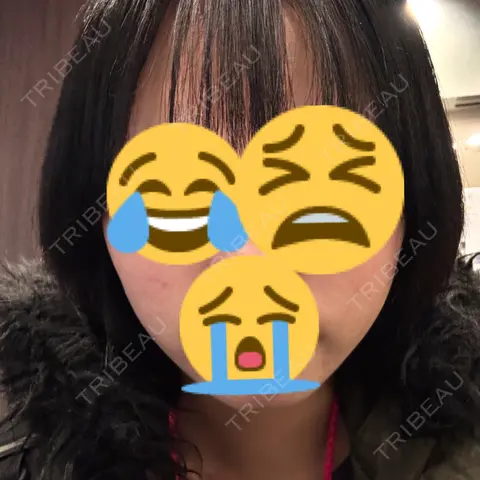 イオン導入 MAクリニック 心斎橋 AFTER