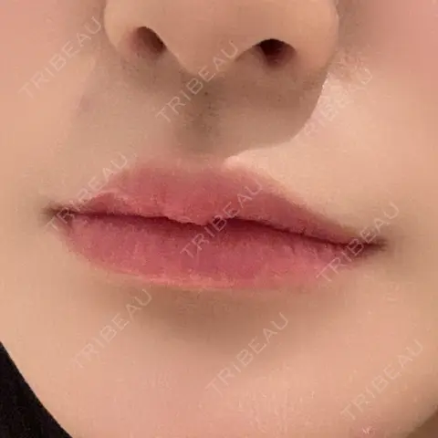 ヒアルロン酸注入（唇） R Beauty CLINIC 銀座院 AFTER