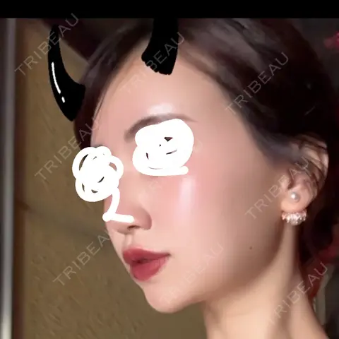 ボトックス（あご） / ヒアルロン酸注入（あご） / ヒアルロン酸注入（唇） / ボトックス（口角） / ヒアルロン酸注入（額） ルラ美容クリニック 大阪本院 AFTER