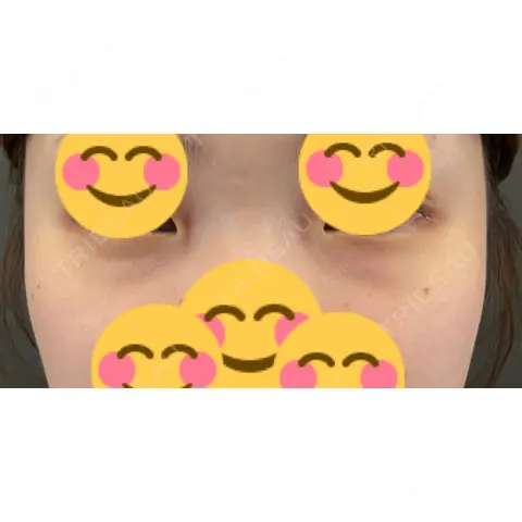 クマ治療 R Beauty CLINIC 大阪院 AFTER
