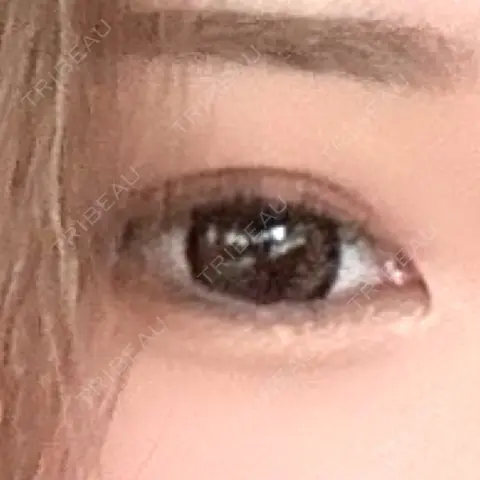 二重埋没 美容外科川崎クリニック 大阪梅田院 AFTER