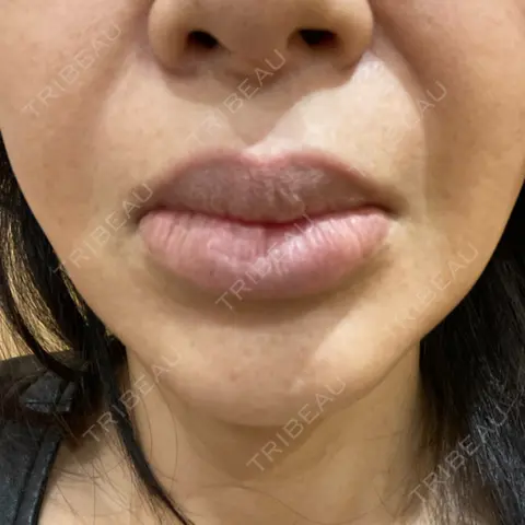 口唇縮小術 / 口角挙上 R Beauty CLINIC 銀座院 AFTER