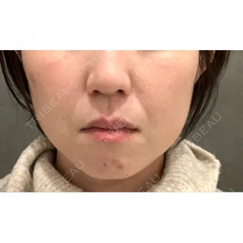 RF（高周波）たるみ治療 RIVER CLINIC（リバークリニック） AFTER