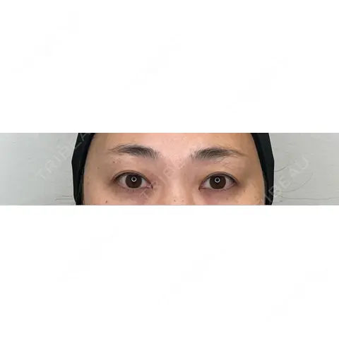 眉下切開 / ボトックス（眉間） / ボトックス（目尻） PRO CLINIC プロクリニック 銀座院 AFTER