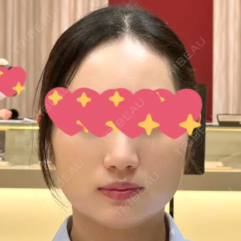 糸リフト / 脂肪吸引（顔） / 脂肪吸引注射（顔） ziz CLINIC AFTER