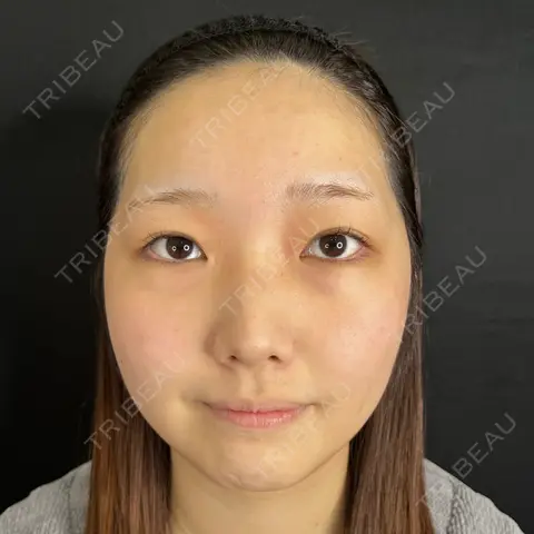 クマ治療 / 脂肪注入（目の下） / ボトックス（あご） 藤・ナチュレ美容クリニック 銀座院 AFTER