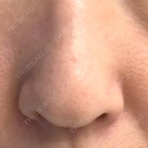 鼻尖形成（切開） / 軟骨移植 / 鼻孔縁下降 / 鼻柱下降・鼻唇角形成（猫手術） もとび美容外科クリニック 新宿院 AFTER
