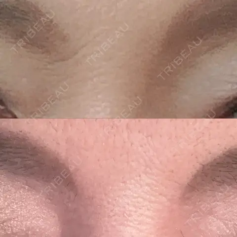 ボトックス（あご） / ボトックス（眉間） / ボトックス（額） / その他（鼻） NARU Beauty Clinic 【ナルクリ】 水戸院 AFTER