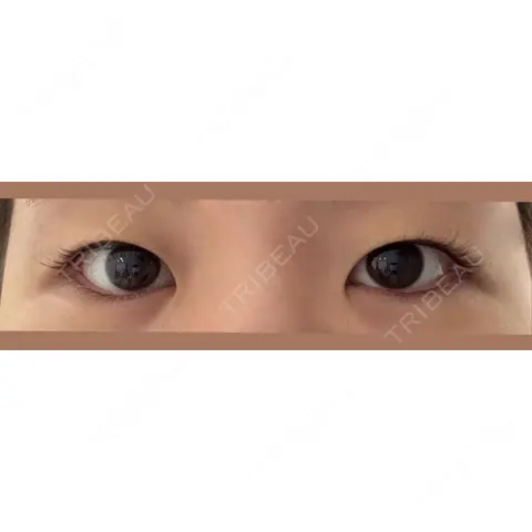 二重埋没 / 目頭切開 / 自然癒着法 Brandnew Beauty Clinic AFTER
