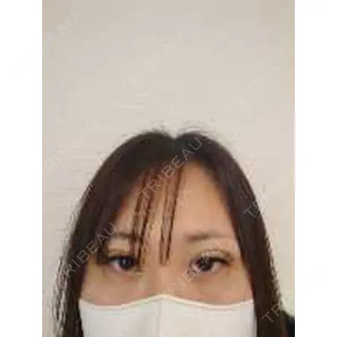 二重埋没 THE FIRST CLINIC 多摩センター院 AFTER