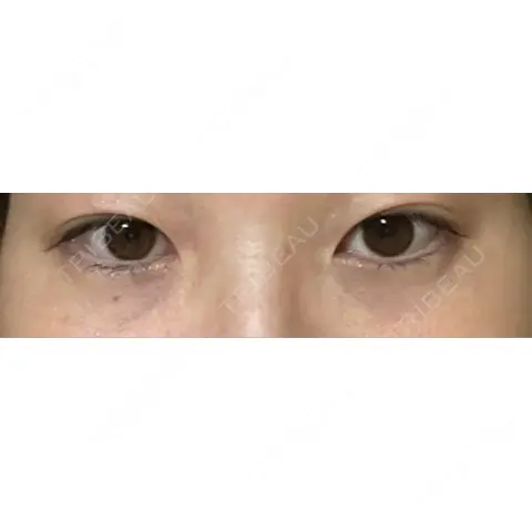 クマ治療 / その他（目元） S Beauty Clinic AFTER