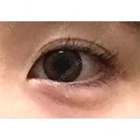 ヒアルロン酸注入（涙袋） AI Beauty Clinic （エーアイ美容クリニック） AFTER