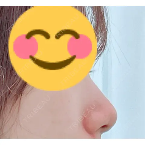 鼻尖形成（切開） / 軟骨移植 / 鼻翼挙上 / 鼻修正 / その他（鼻） 東京シンデレラ美容外科 大宮院 AFTER