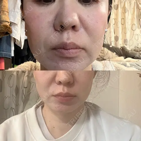 RF（高周波）たるみ治療 RIVER CLINIC（リバークリニック） AFTER