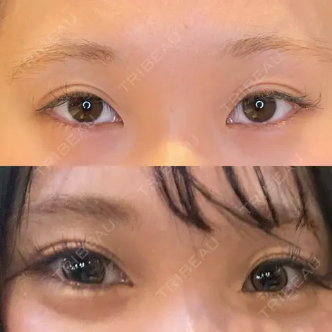 目尻切開 / タレ目形成・グラマラスライン（埋没） LOUIS CLINIC 二子玉川院【ルイクリニック】 AFTER