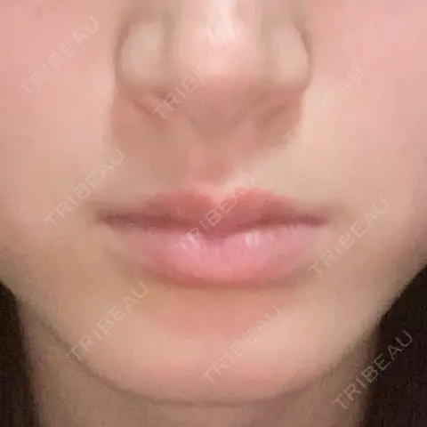 ボトックス（あご） / ボトックス（口角） / シワ取りボトックス / ボトックス（人中） / ボトックス（ガミースマイル） LE CLINIC AFTER