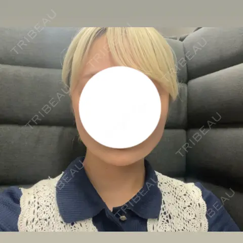 ボトックス（エラ・小顔） 日比谷セントラルクリニック AFTER