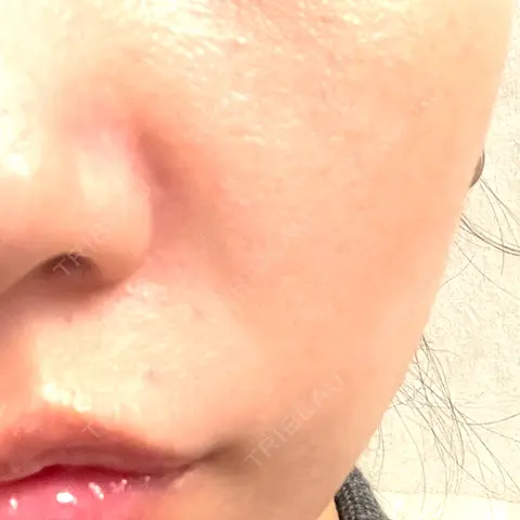 ボトックス（あご） / ボトックス（口角） / ボトックス（額） BiBiクリニック AFTER