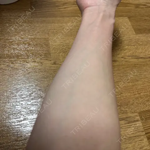 高濃度ビタミンC点滴 HELLATH CLINIC 新宿院 AFTER