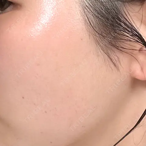 イオン導入 / 毛穴洗浄（ハイドラフェイシャルなど） / 光治療（フォトフェイシャルなど） / その他（鼻） ルラ美容クリニック 札幌院 AFTER