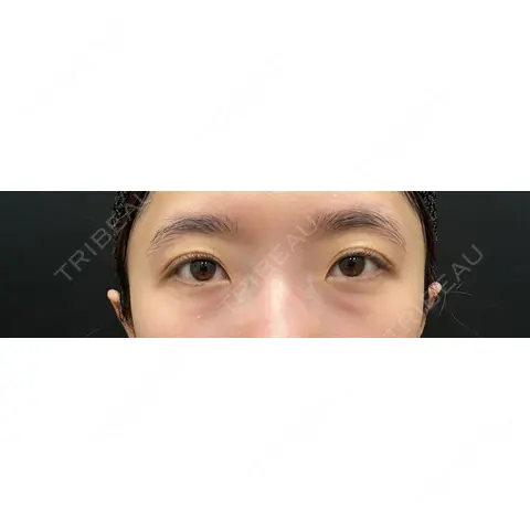クマ治療 / 下まぶたの脂肪取り / 脂肪注入（目の下） 藤・ナチュレ美容クリニック 銀座院 AFTER