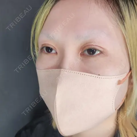 クマ治療 / ヒアルロン酸注入（目の下） / スネコス Tokyo Tensei Clinic 新宿院 AFTER