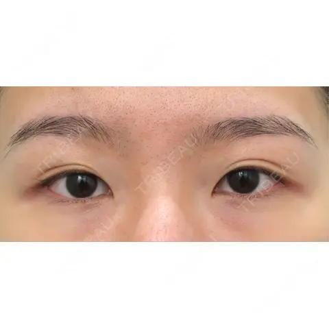 クマ治療 WOM CLINIC GINZA （ワム クリニック ギンザ） AFTER