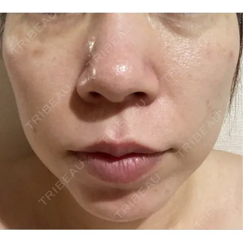 クマ治療 / 脂肪吸引（顔） / ジョールファット除去 R Beauty CLINIC 大阪院 AFTER