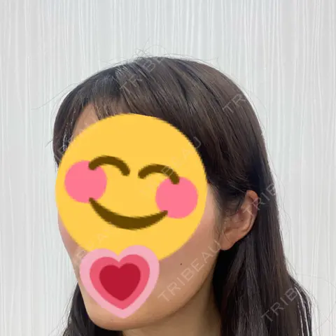 ボトックス（エラ・小顔） / ヒアルロン酸注入（頬） TCB東京中央美容外科 新宿三丁目院 AFTER