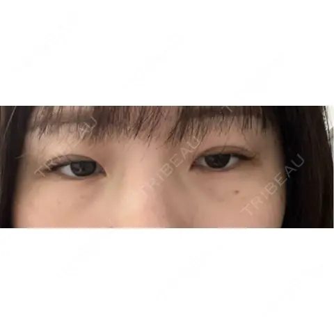 クマ治療 / 下まぶたの脂肪取り / ヒアルロン酸注入（唇） / ヒアルロン酸注入（目の下） / その他（目元） ROOTS Clinic AFTER