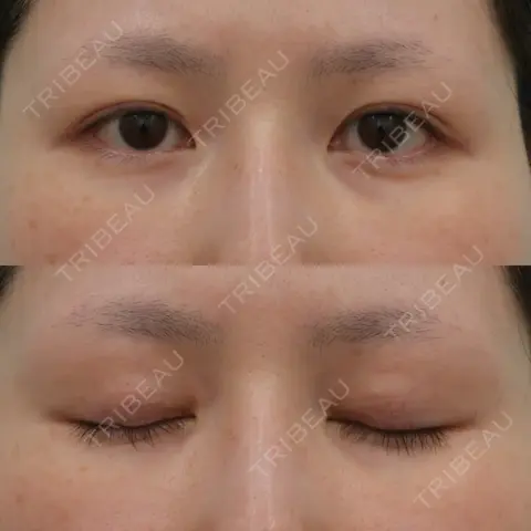 二重埋没 WOM CLINIC GINZA （ワム クリニック ギンザ） AFTER