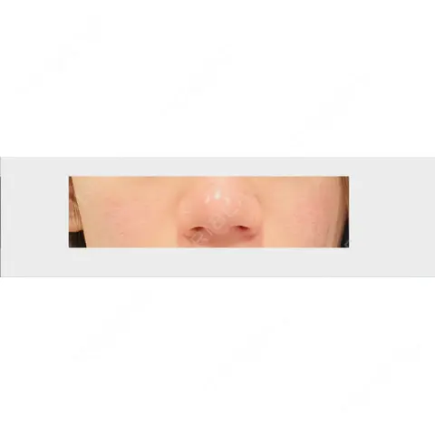 鼻尖形成（切開） / 鼻中隔延長（切開） / 小鼻縮小（切開） / 軟骨移植 R Beauty CLINIC 大阪院 AFTER
