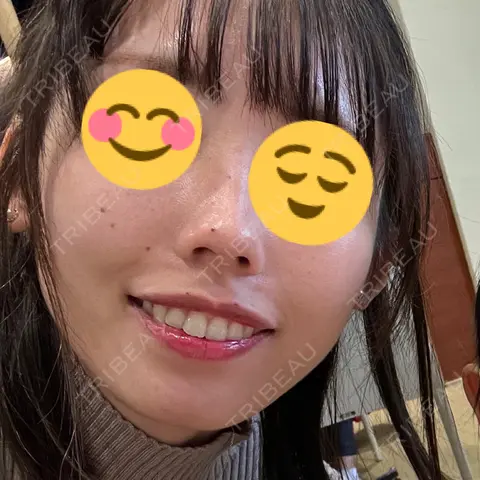 ほくろ・いぼ切除（肌） KARIS beauty clinic AFTER