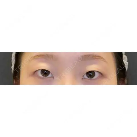 二重埋没 / 目頭切開 LOUIS CLINIC 二子玉川院【ルイクリニック】 AFTER