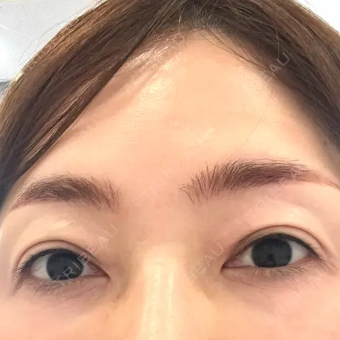 ヒアルロン酸注入（涙袋） / ハイフ（顔） ルラ美容クリニック 札幌院 AFTER