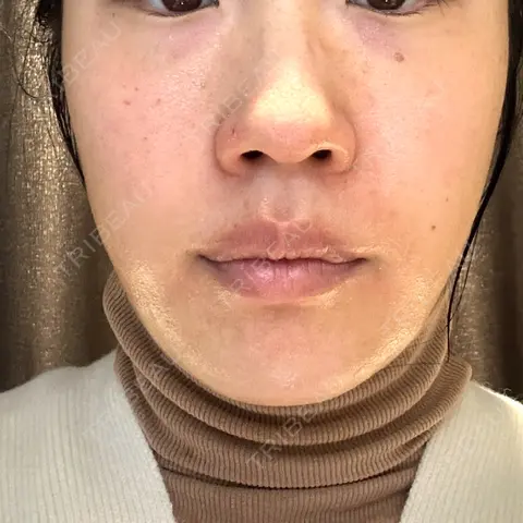 糸リフト / クマ治療 / 下まぶたの脂肪取り LE CLINIC AFTER