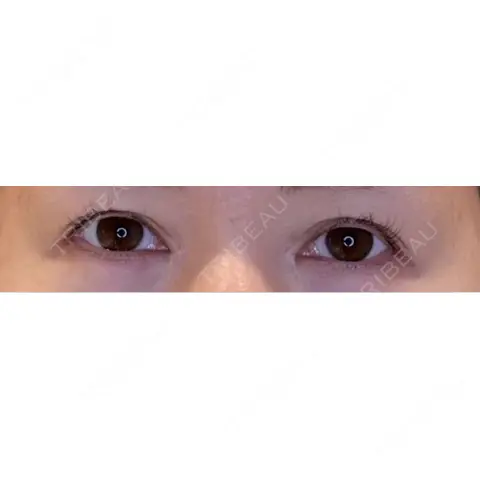 目尻切開 / タレ目形成・グラマラスライン（埋没） LOUIS CLINIC 二子玉川院【ルイクリニック】 AFTER