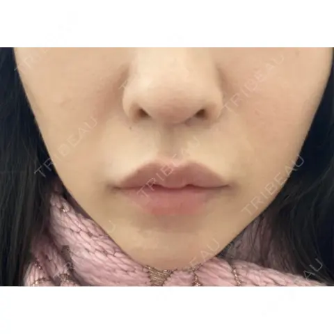ヒアルロン酸注入（唇） / ヒアルロン酸注入（鼻翼基部） BiBiクリニック AFTER