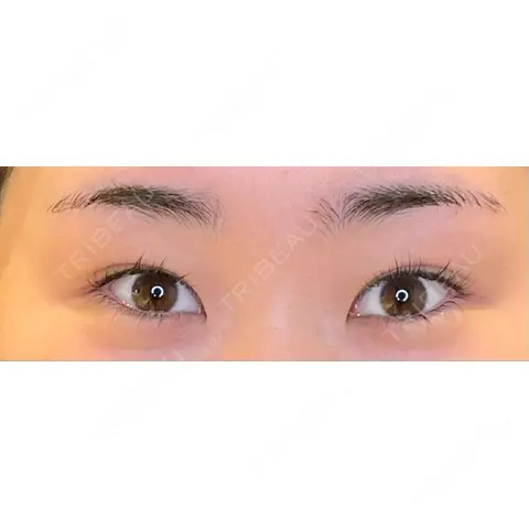 目尻切開 / タレ目形成・グラマラスライン（埋没） LOUIS CLINIC 二子玉川院【ルイクリニック】 AFTER