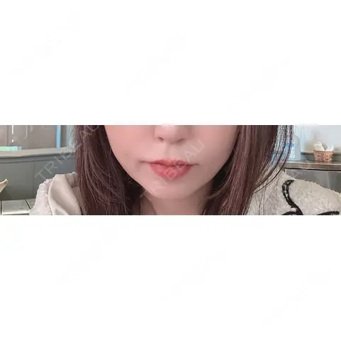 ヒアルロン酸注入（唇） / ピーリング（ニキビ・毛穴） / ルメッカ ルラ美容クリニック 名古屋栄院 AFTER