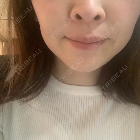 ピコレーザートーニング（美白・肝斑） TCB東京中央美容外科 郡山院 AFTER