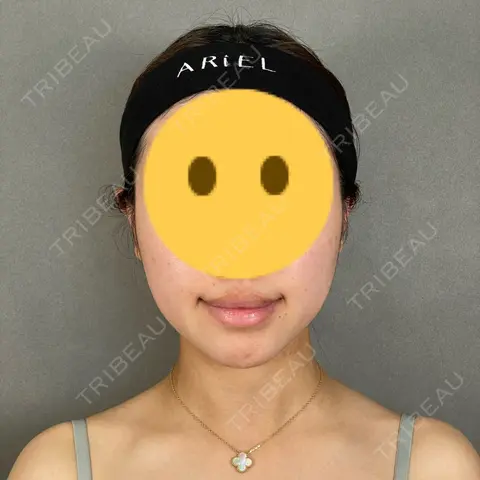 糸リフト / バッカルファット除去 / 脂肪吸引（顔） / ボトックス（エラ・小顔） アリエル美容クリニック 大宮院 AFTER