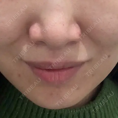 糸リフト / 脂肪吸引注射（顔） 湘南美容クリニック 高田馬場院 AFTER